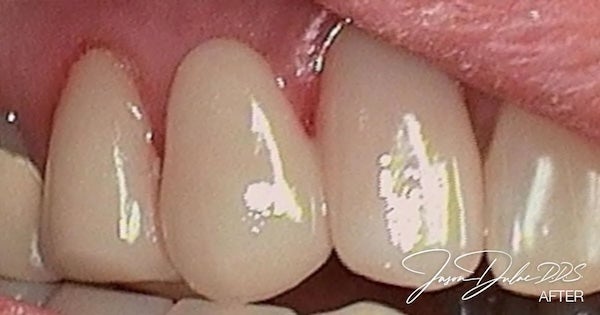 Bridge replacement after