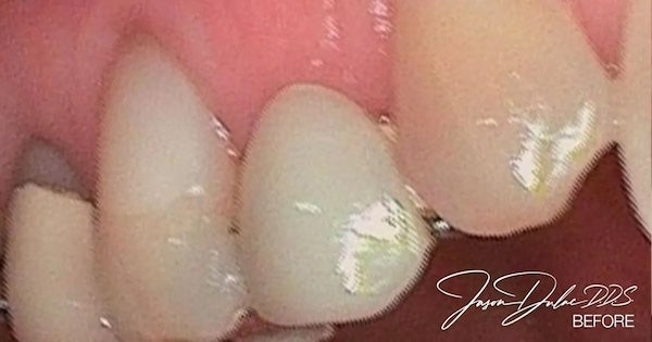 Bridge replacement before