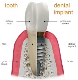 Implants1-2