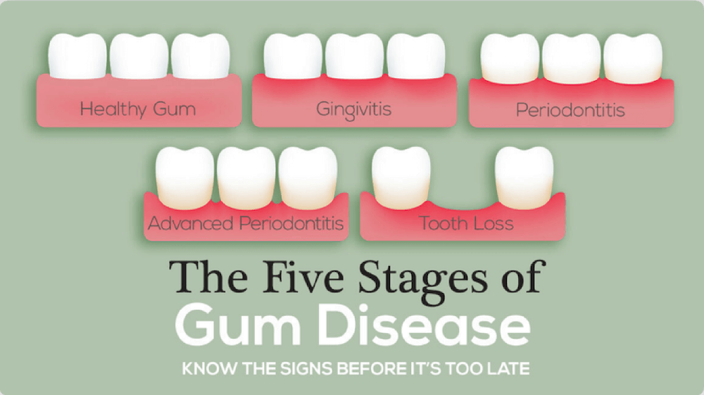 Stages of gum disease